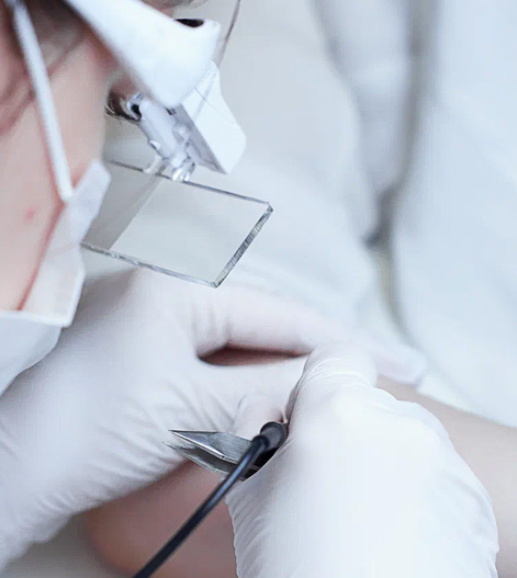 Электроэпиляция